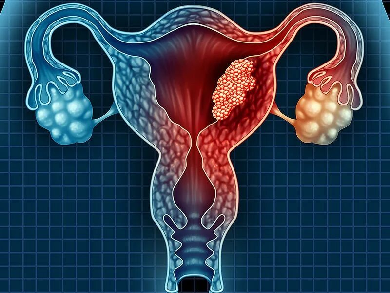 Cervix Disorders Cervicitis Cervical Polyp MedlinePlus