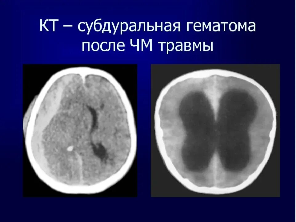 Черепно мозговые гематомы. Посттравматическая субдуральная гематома. Субдуральная гематома на кт. Обызвествленная субдуральная гематома. Субдуральная гематома осложнения.