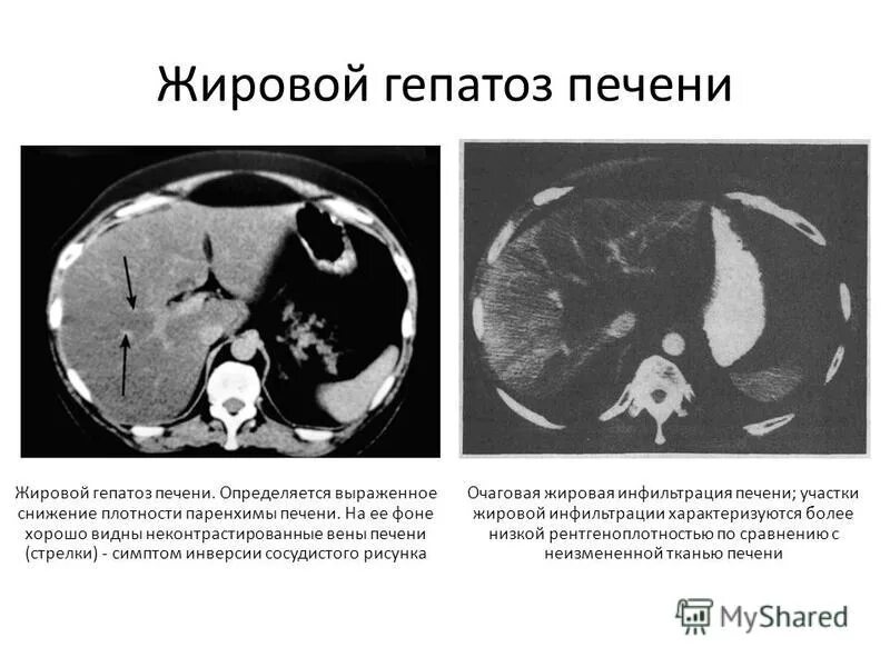 Диффузное уплотнение печени