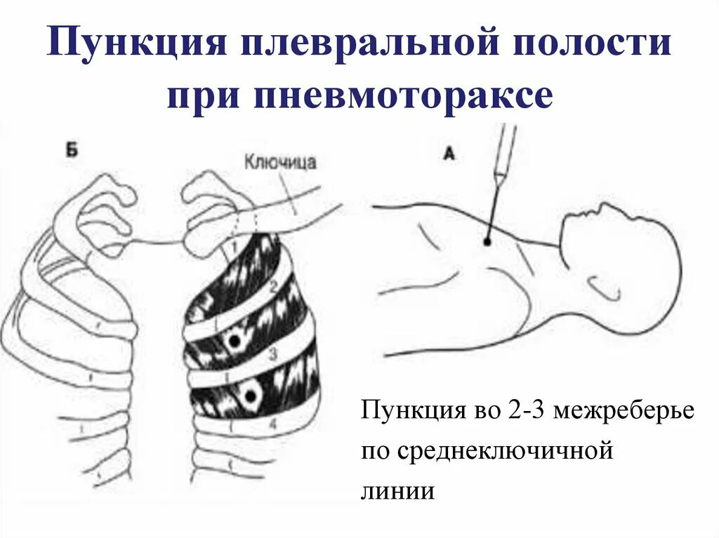 Пункция грудной клетки при гидротораксе. Плевральная пункция при пневмотораксе. Методика выполнения пункции плевральной полости. Торакоцентез плевральной полости. Пункция плевральной полости во 2 межреберье.