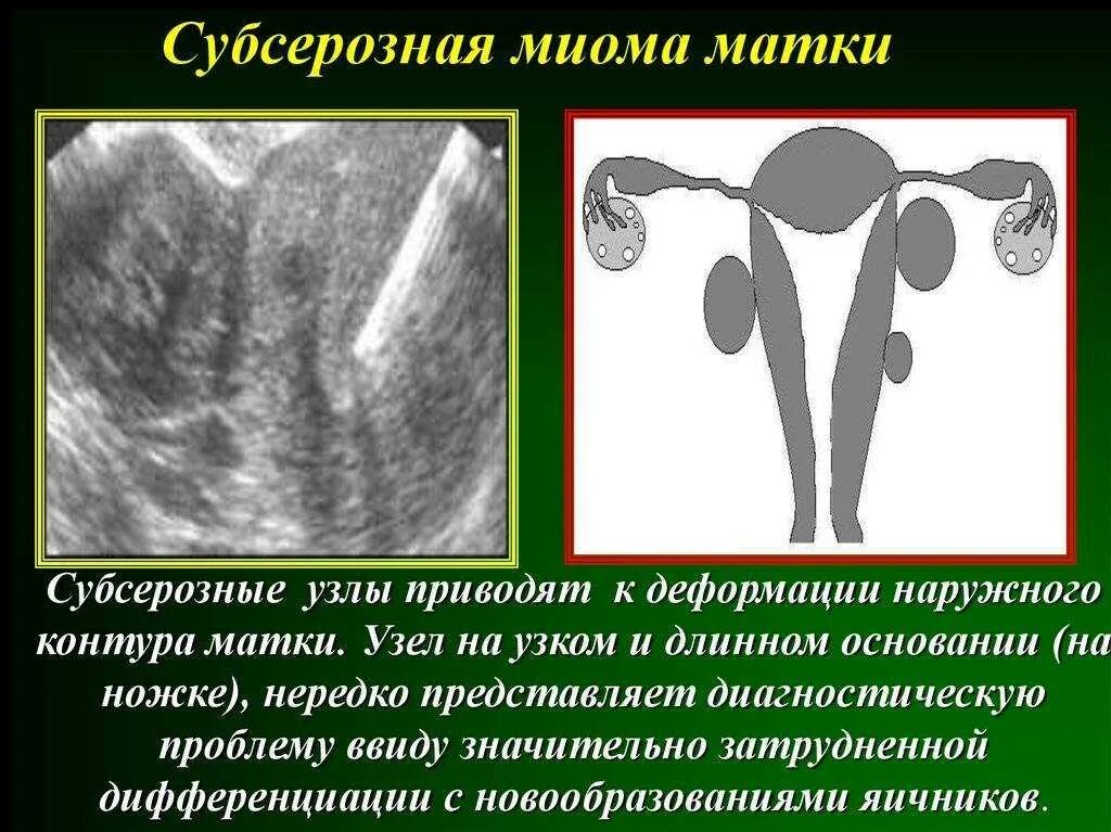 Основной клинический симптом субсерозной миомы. Субсерозные миоматозные узлы матки что. Миома матки субсерозный узел. Полость матки деформирована