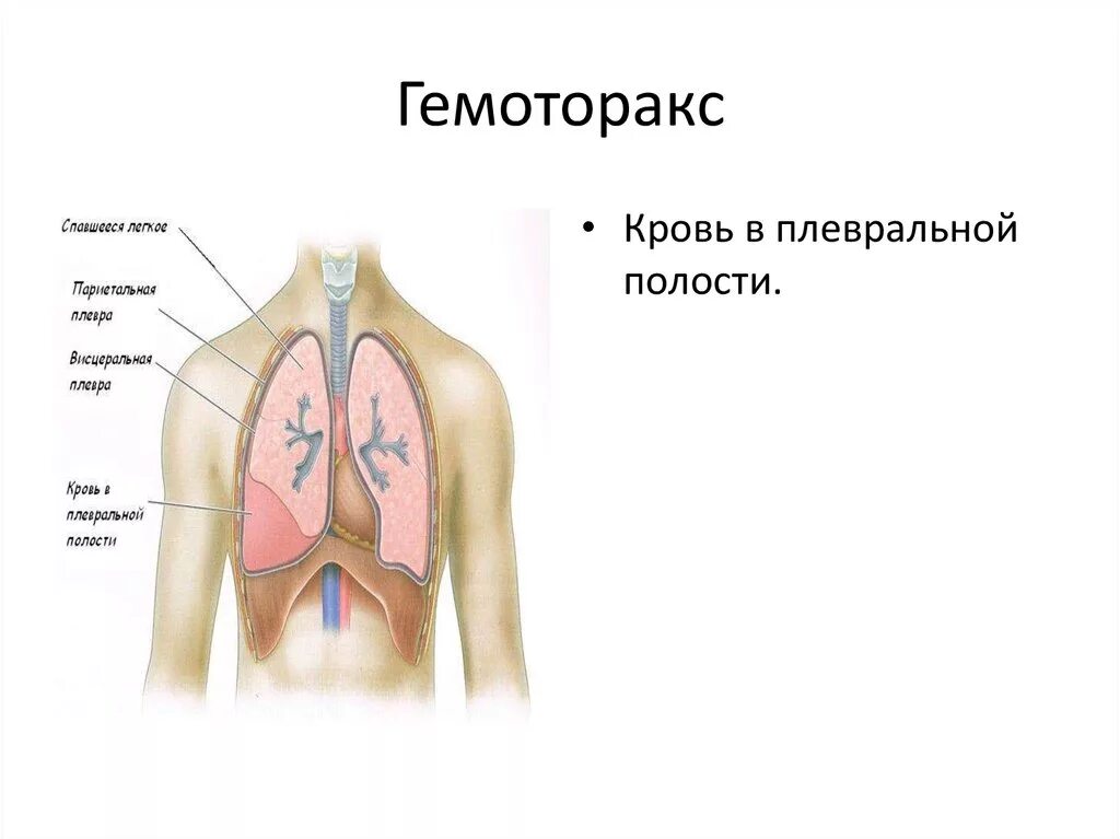 Правосторонний гемоторакс. Травма плевральной полости. Травмы грудной клетки гемоторакс.