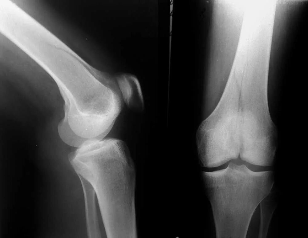 Берцовая кость в коленном суставе. Мыщелка тазобедренного сустава. Латеральный отдел коленного сустава. Латеральный мыщелок бедренной кости в коленном суставе. Мыщелка тазобедренного сустава.