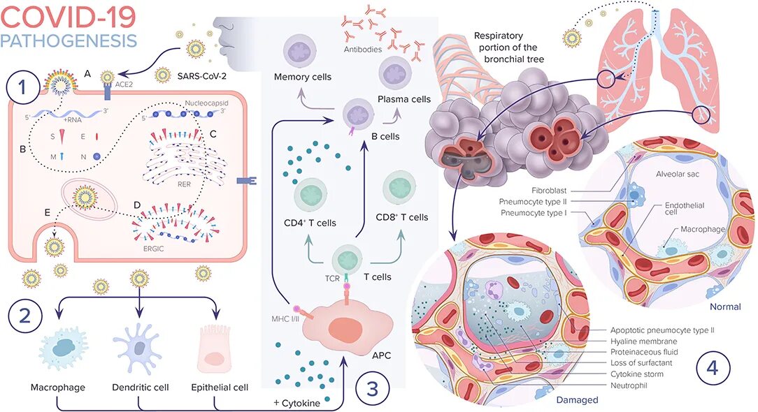 Развитие ковид. Коронавирусная инфекция патогенез. Патогенез SARS-cov-2. Патогенез коронавирусной инфекции схема. SARS cov патогенез.