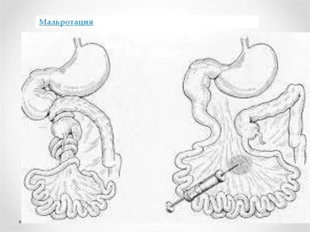 Резекция желудка анемия. Синдром Ледда клинические рекомендации. Мальротация толстой кишки. Мальротация синдром Ледда.