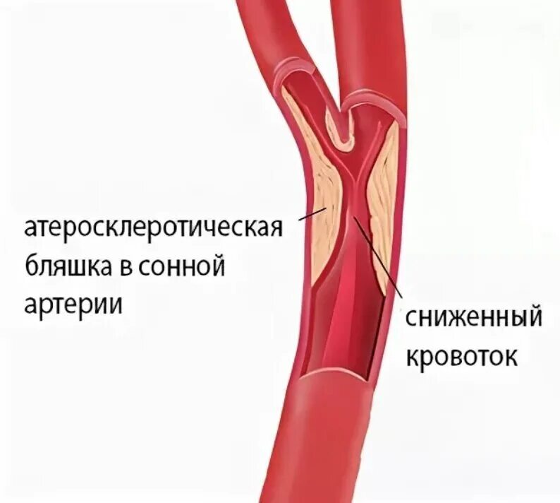 Тромбы после инсульта