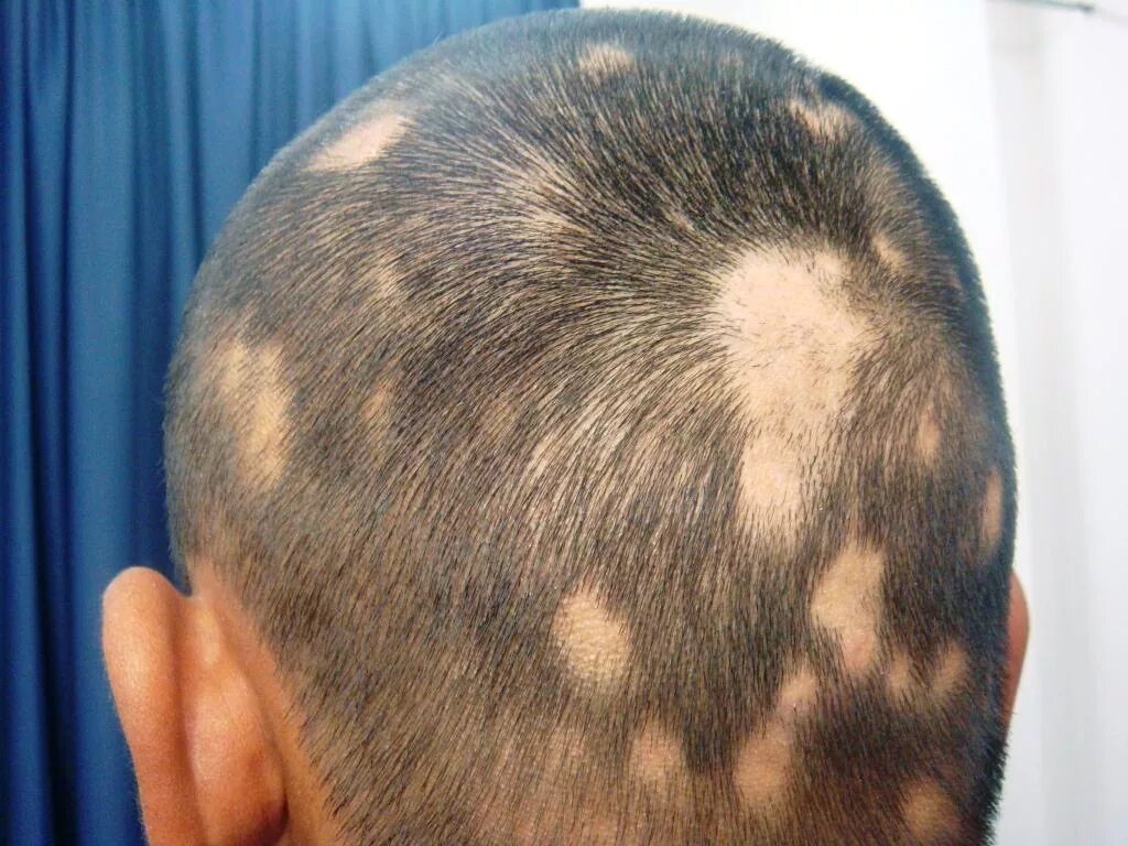 Выпадение волос головы причина лечение. Очаговая алопеция офиазис. Очаговая (гнездная) алопеция.