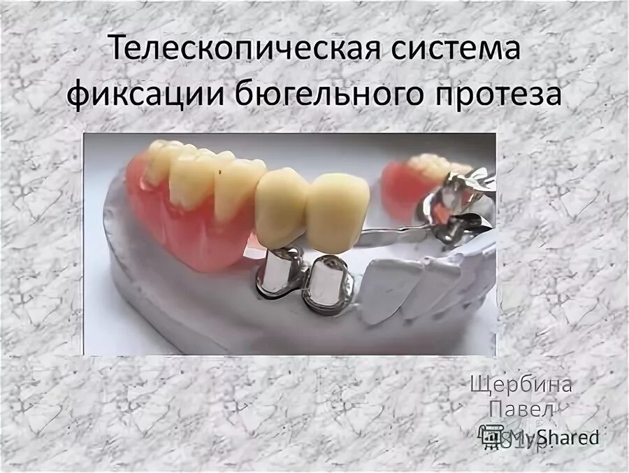 бюгельный протез состоит из