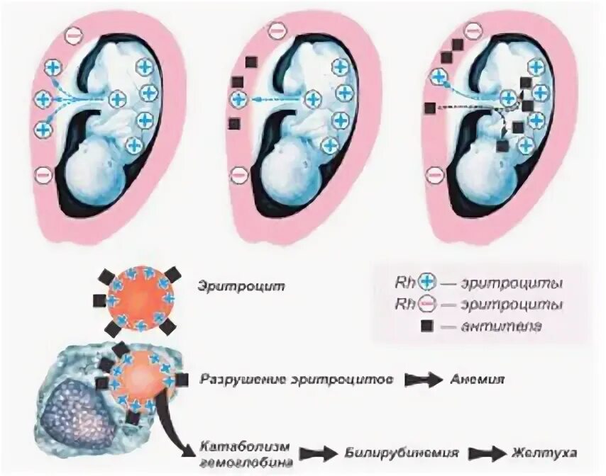 Несовместимость крови матери и плода. Гемолитическая болезнь новорожденных патогенез. Этиология ГБН У новорожденных. Гемолитическая болезнь плода схема. Гемолитическая болезнь новорожденных резус фактор.