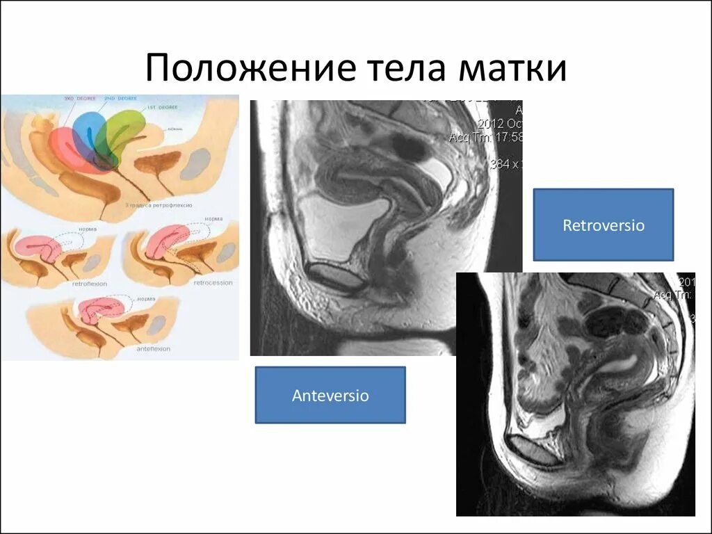 Нормальное положение матки. Положение матки. Антефлексио версио матка. Перегиб матки anteflexio. Нормальное положение матки.