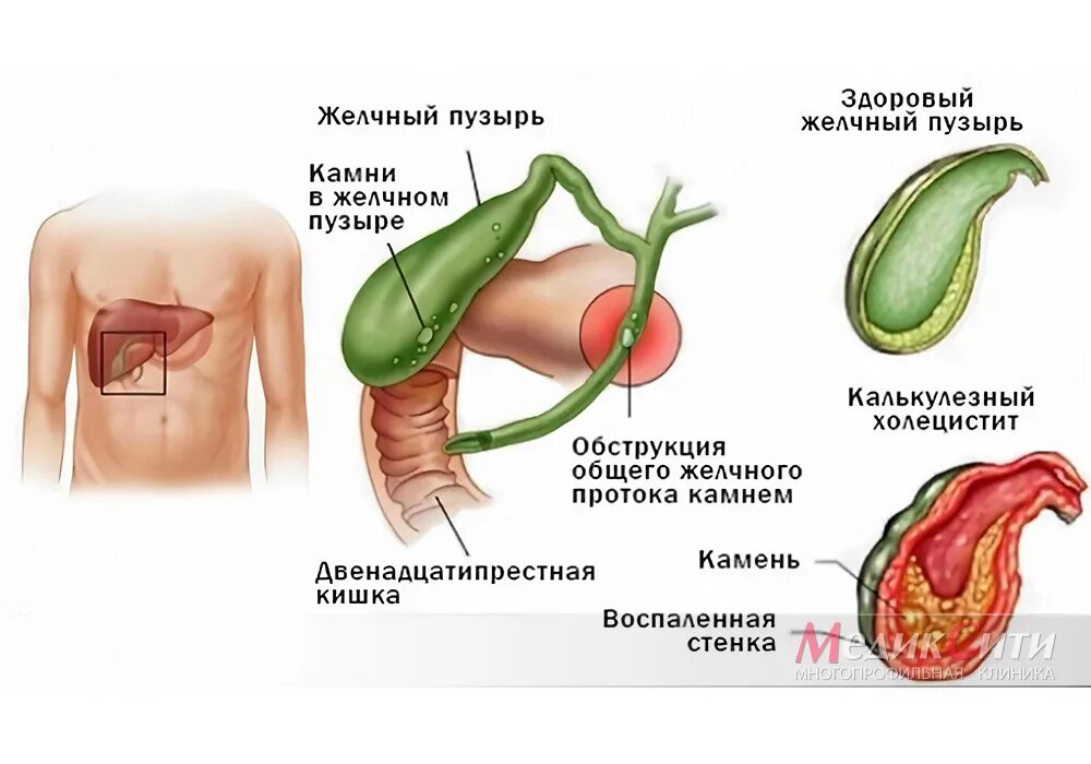 Симптомы плохой желчи. Желчнокаменная болезнь холецистит. Хронический холецистит рисунок. Болезни желчного пузыря патология. Острый бескаменный холецистит.