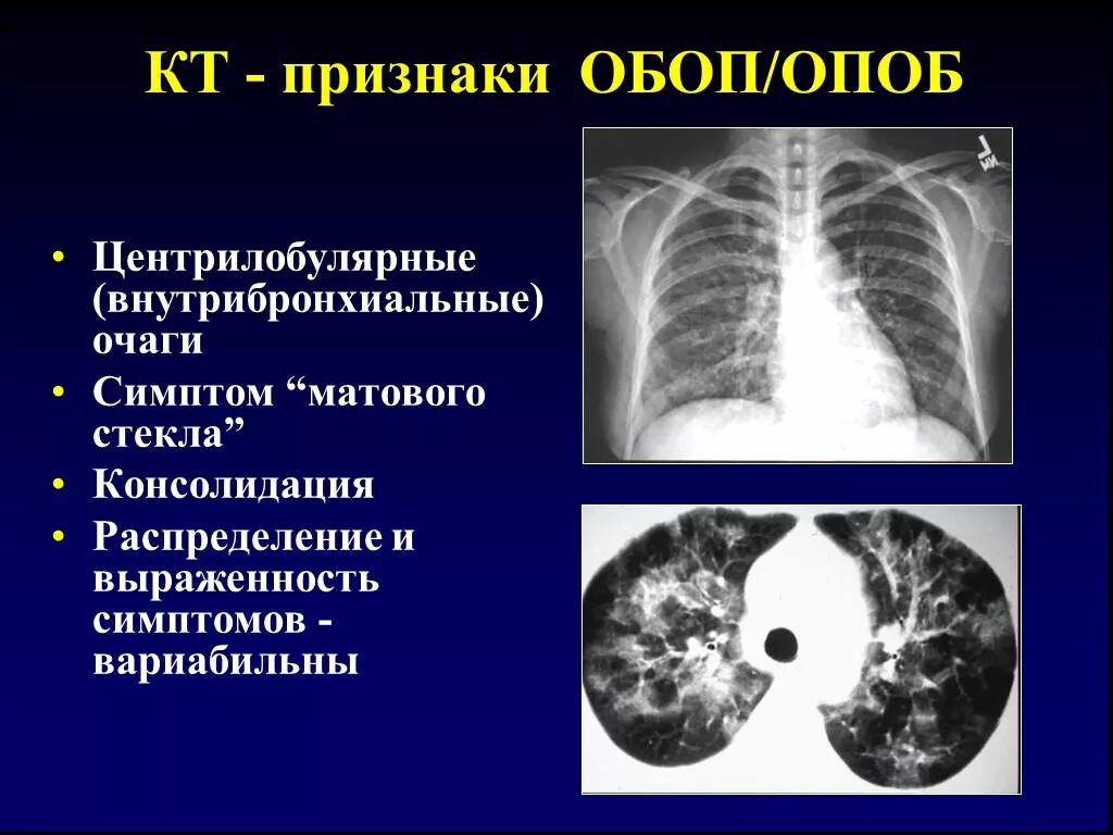 Дерева в почках в легких кт. Перибронхиальные очаги кт. Бронхиолит на кт. Очаги матового стекла на кт. Симптом матового стекла на кт.