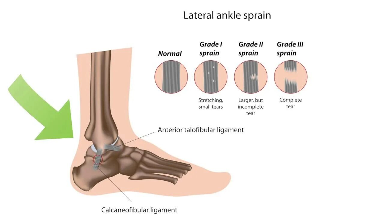 Степени растяжения связок лодыжки. Растяжение голеностопа 2 степени. Степени повреждения связок голеностопа. Растяжение связок лодыжки 1 степени. Трещина связке