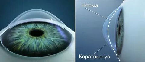 Роговица развивается