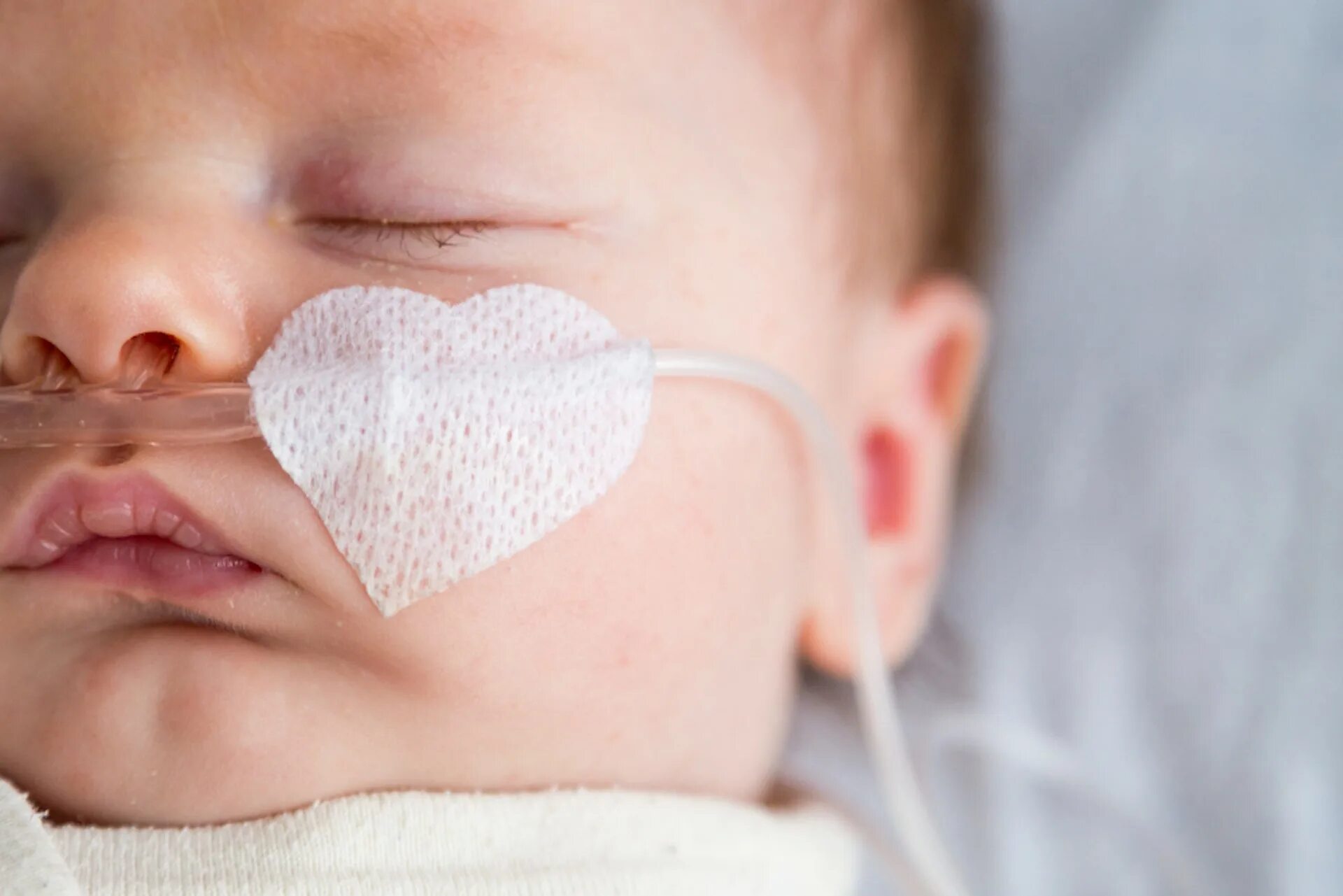 Асфиксии новорожденных клинические. Носовые канюли для новорожденных. Асфиксия новорожденных. Родовые травмы новорожденных. CPAP через носовые канюли у новорожденных.