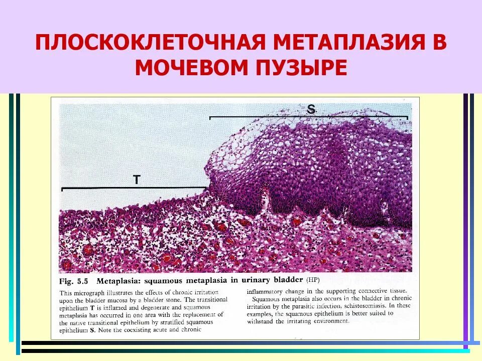 Реактивные изменения метаплазированных клеток. Плоскоэпителиальная метаплазия. Плоскоклеточная метаплазия гистология. Метаплазия эндометрия гистология. Плоскоклеточный эпителий шейки матки.