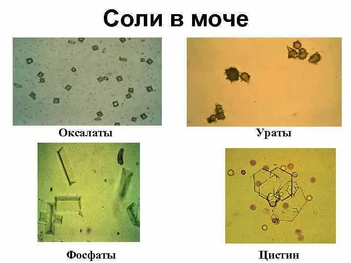 Повышен цистин в моче. Микроскопия мочи Ураты. Оксалаты микроскопия мочи. Аморфные фосфаты микроскопия мочи. Аморфные Ураты микроскопия мочи.