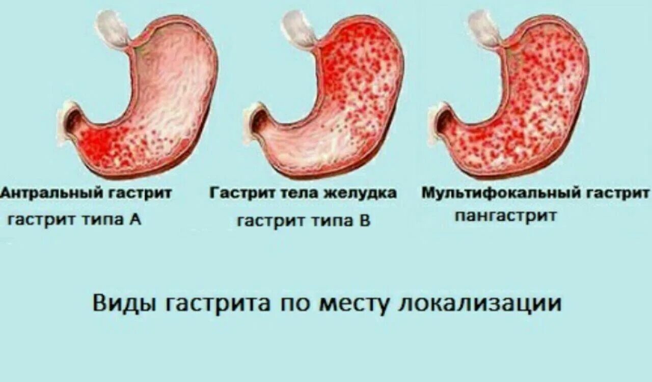 Кислотность желудка язва желудка. Хронический гастрит антрального отдела желудка. Хронический атрофический антральный гастрите желудка. Желудок с повышенной кислотностью.