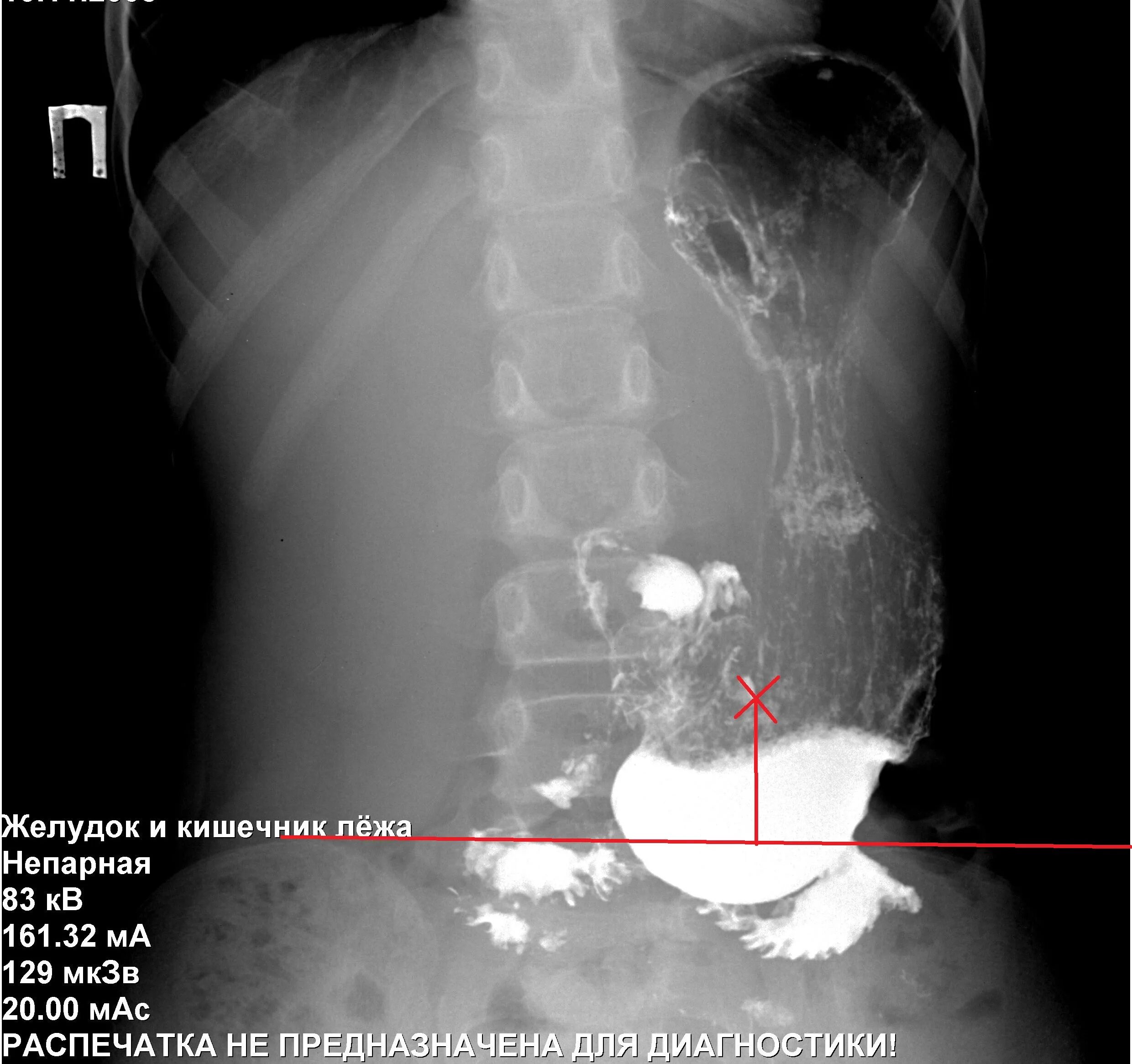 Гастроптоз 3 степени. Врожденный гастроптоз. Опущение желудка симптомы. Гастроптоз желудка рентген. Гастроптоз 3 степени.
