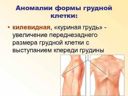 Неправильная форма грудных