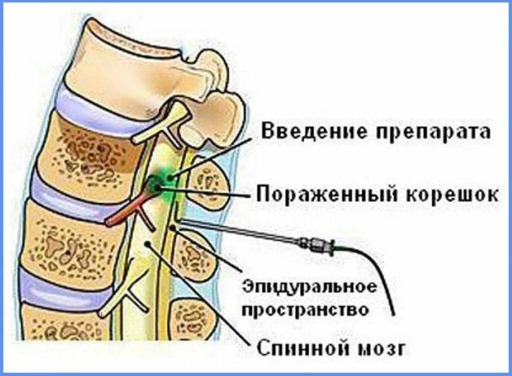 Можно ставить блокаду. Блокада грыжи поясничного отдела позвоночника. Блокада пояснично-крестцового отдела схема. Блокада позвоночника эпидуральная поясничного. Корешковая блокада пояснично-крестцового отдела позвоночника.