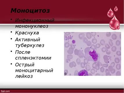 Острый моноцитарный лейкоз
