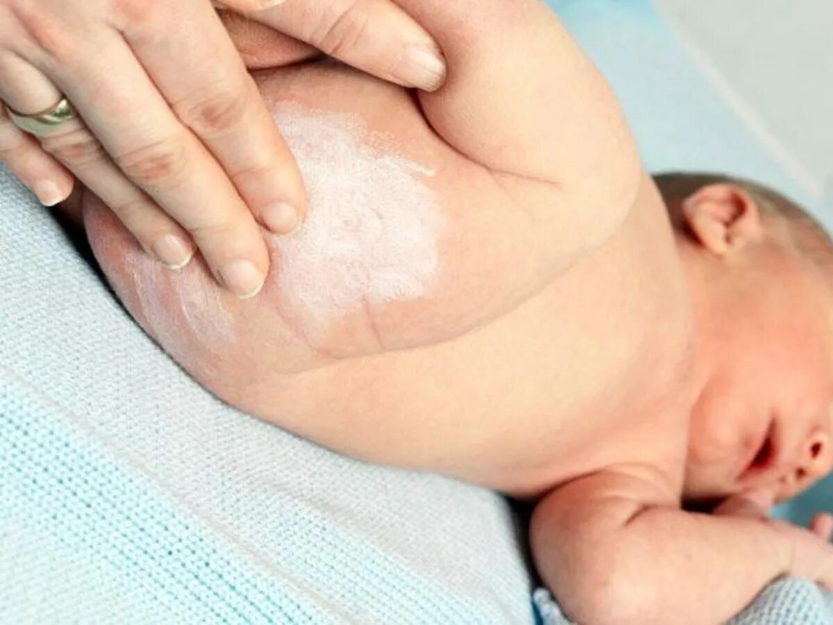 Подкожный адипонекроз новорожденных. Пеленочный дерматит у младенца. Пеленочный дерматит у новорожденных.