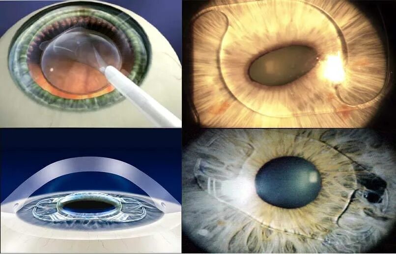 Катаракта факоэмульсификация. Имплантация факичных интраокулярных линз. Действие после операции катаракта