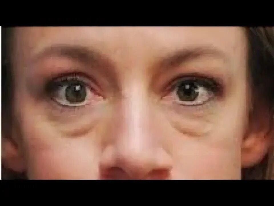 Как убрать ОТЕКИ ПОД ГЛАЗАМИ? Мешки под глазами, отеки верхнего века. - YouTube