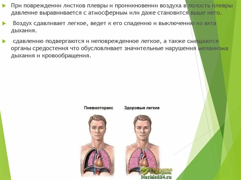 Попадание воздуха в полость. Ранение в грудную клетку пневмоторакс. Проникающее ранение в плевральную полость. При ранение плевральной полр. При равнении плевральной полости.