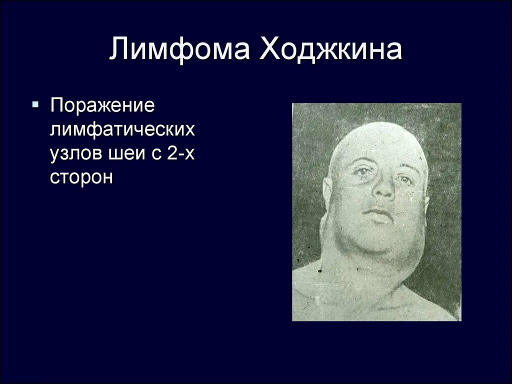 История лимфомы. Limfomul Hodjkin. Классическая лимфома Ходжкина.