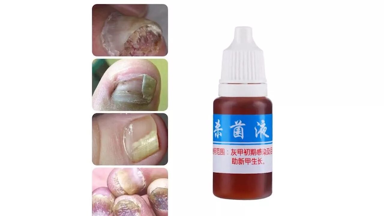 Средство от грибка дешевые. Китайское средство от грибка ногтей nail fungus. средство от грибка ногтей bright nail repair. китайский препарат от грибка ногтей. китайские средства от грибка на ногах.
