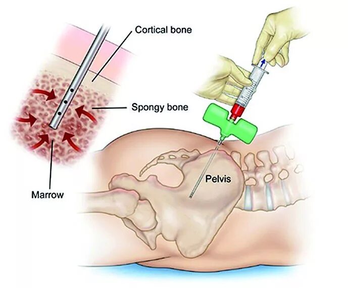 Почему делают биопсию. Трепанобиопсия костного мозга. Техника проведения биопсии костного мозга.