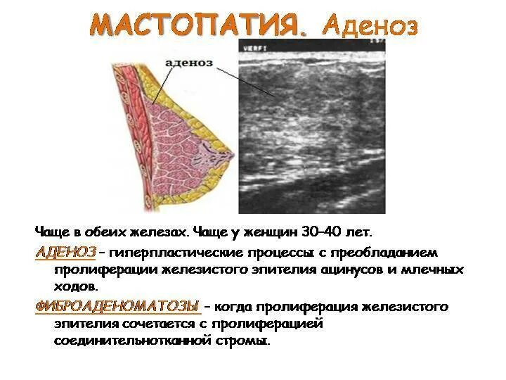 Что такое фиброаденоз молочной железы