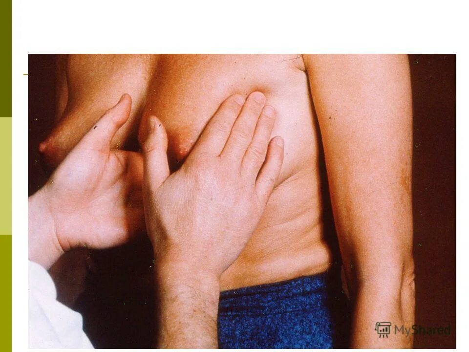 апельсиновая корка на лице. грудь фрукты. апельсиновая кожа. апельсиновая корка на коже молочной железы. апельсиновая корка на груди при онкологии.