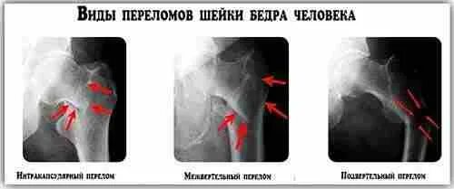 Перелом шейки бедра симптомы как определить. Операция перелом шейки бедра в 80 лет. перелом основания шейки бедра со смещением. перелом шейки бедра клиника. перелом шейки бедра симптомы.