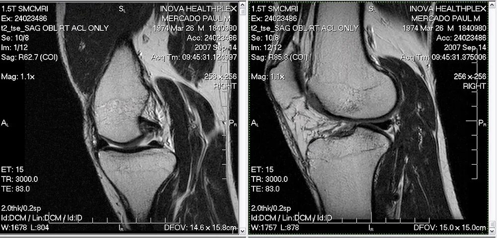 Мрт коленного сустава по полису. Снимки мрт коленного сустава. Мрт исследование коленного сустава. Сагиттальная проекция мрт коленный сустав.
