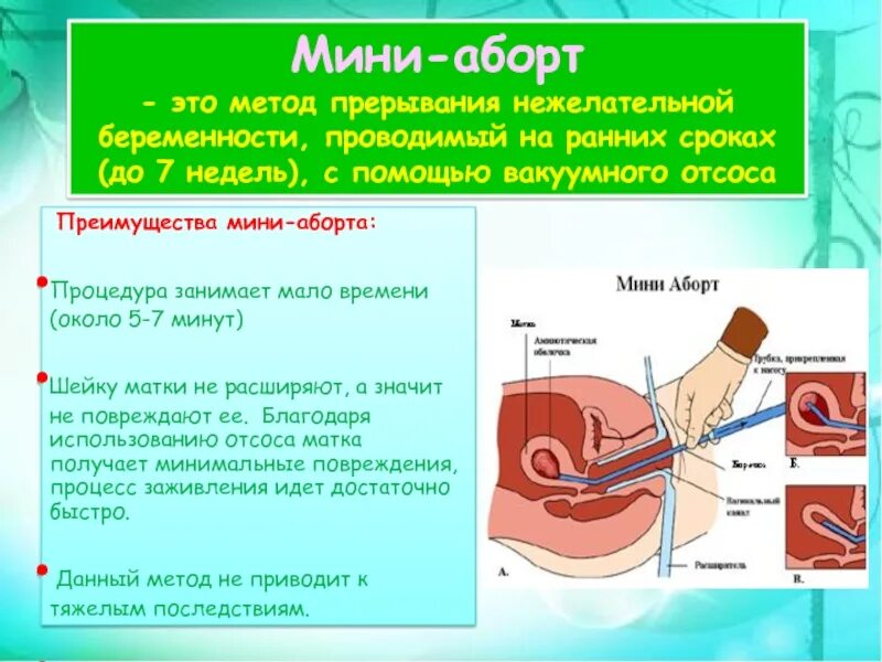 Сколько длится вакуумный. Вакуумный аборт на ранних.сроках. Вакуумный аборт (мини-аборт). До какого срока делается вакуумный аборт. Вакуумный метод прерывания беременности.