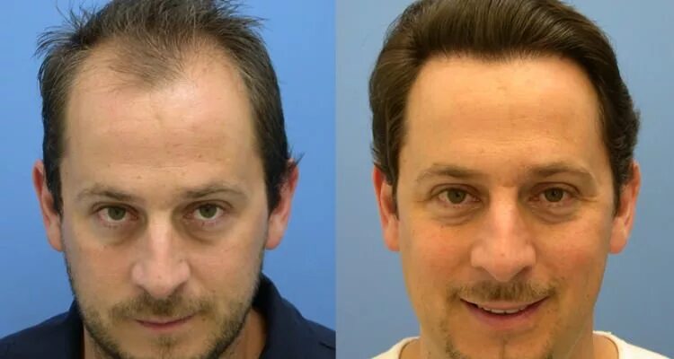 Пересадка волос результаты до и после Hair Transplant Hair transplant, Hair, Dental treatment