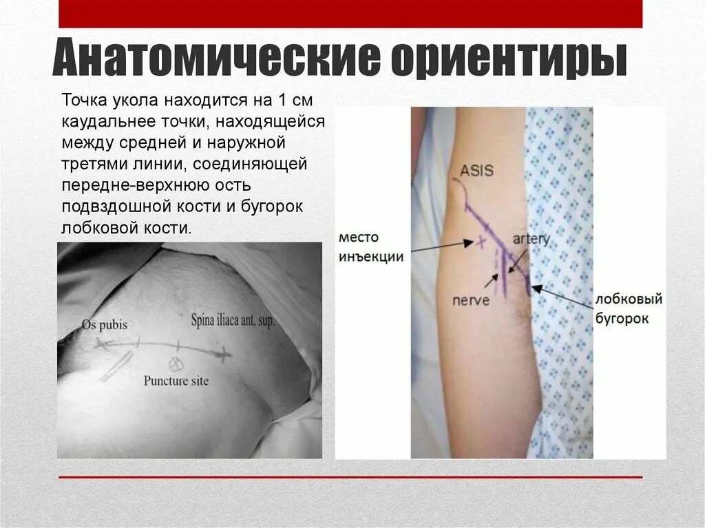 Укол точка голода отзывы. Анатомические ориентиры. Линии анатомических ориентиров. Ориентиры в анатомии. Линия соединяющая передние Верхние ости подвздошных костей.