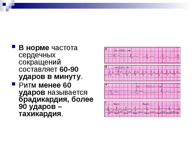 Тахикардия у ребенка 10 лет. Частота сокращения сердца в минуту. частота сердечных сокращений ударов в минуту. чсс 96 в минуту называется. 120 ударов тахикардия.