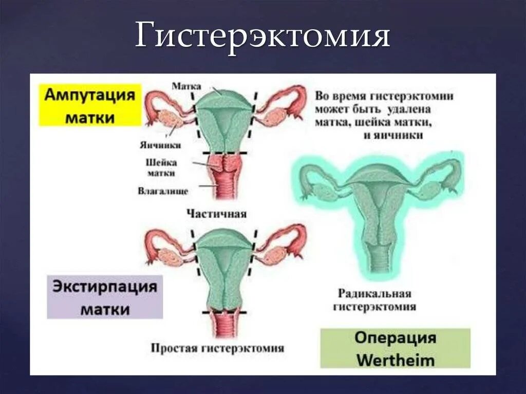 Удаление матки и яичников при онкологии. Экстирпация матки ампутация матки отличия. Энергосберегающая расширенная экстирпация матки с придатками. Влагалищная тотальная гистерэктомия. Ампутация матки матки отличия.