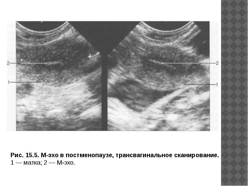 Эндометрий 9мм. Измерение толщины эндометрия на УЗИ. М Эхо 1,2 мм. М-Эхо 7.9 мм это. М-Эхо: 1.9 мм.