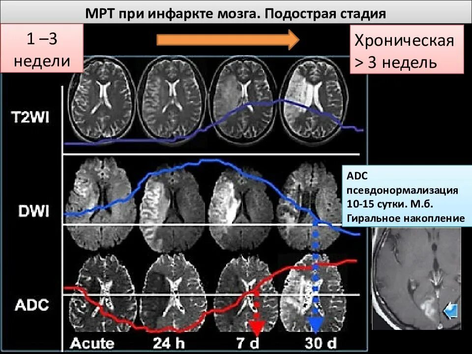 Ишемический инсульт мрт Dwi. Стадии ишемического инсульта на мрт. Стадии ишемического инсульта на кт. Подострая стадия ишемического инсульта мрт. Очаги ишемии головного мозга