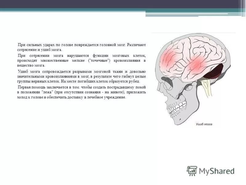 Удар затылком сотрясение