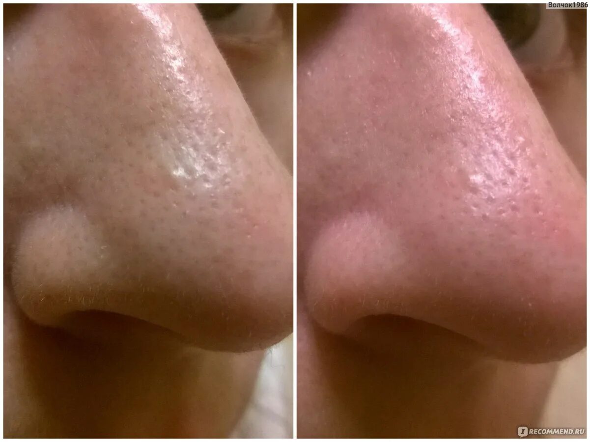 Пилинг от черных точек. Мезоботокс скинбустер. Глубокий лазерный пилинг. Лазерный карбоновый пилинг. Пилинг от расширенных пор.