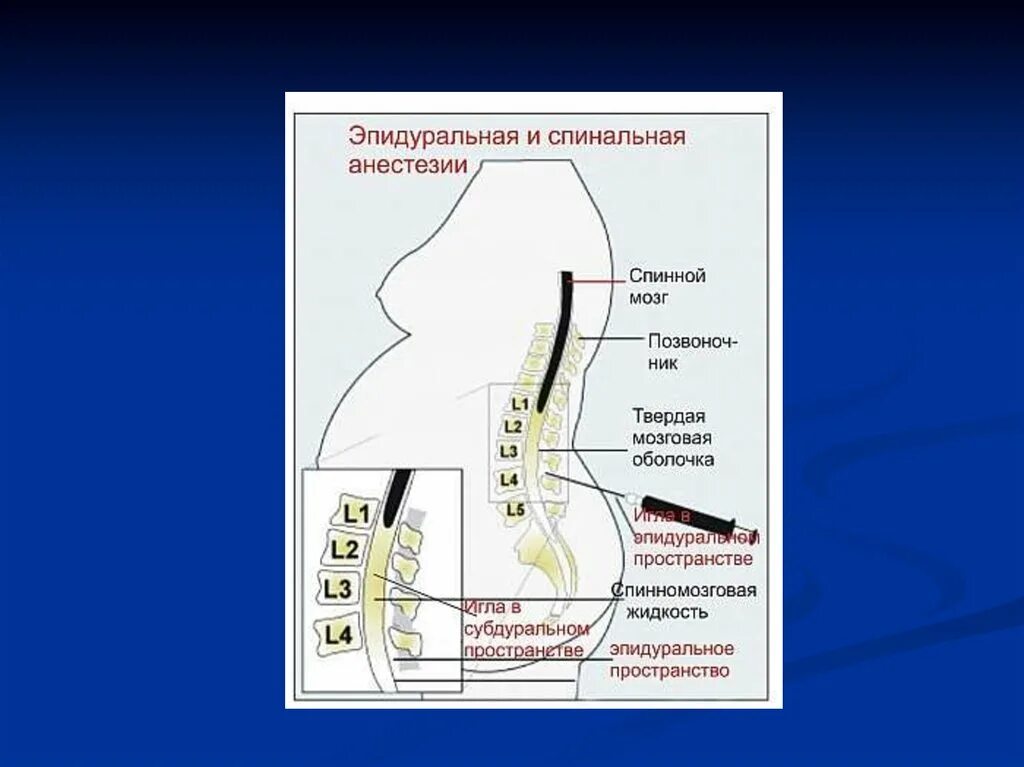 Эпидуральная спинная. Спинальная и эпидуральная анестезия. Анатомические ориентиры для эпидуральной анестезии. Спинальная анестезия анатомические ориентиры. Проводниковая анестезия спинномозговая.