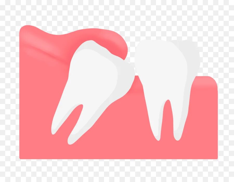 Зуб. Мудрый зуб стоматология. Зуб картинка. Удаление зуба семерки