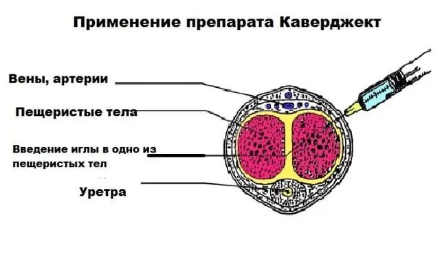 Инъекции каверджект. Схема инъекции Каверджект. Интракавернозная инъекция Каверджект. Инъекция в пенис Каверджект. Инъекции папаверина в пещеристое тело.