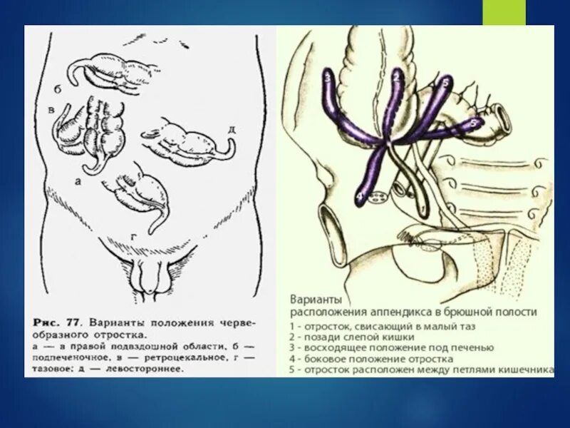 Варианты расположения червеобразного отростка Аппендикса ретроцекальный
